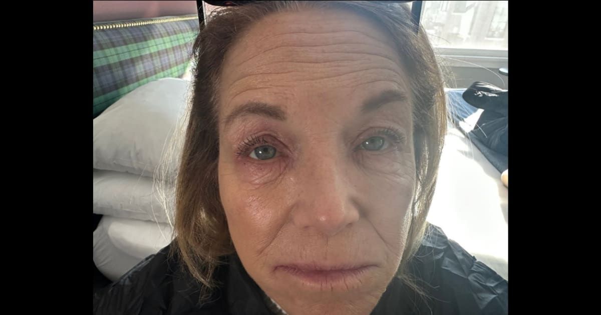Katie Couric shares candid photo of eczema flare-up on Instagram (@katiecouric/Instagram)