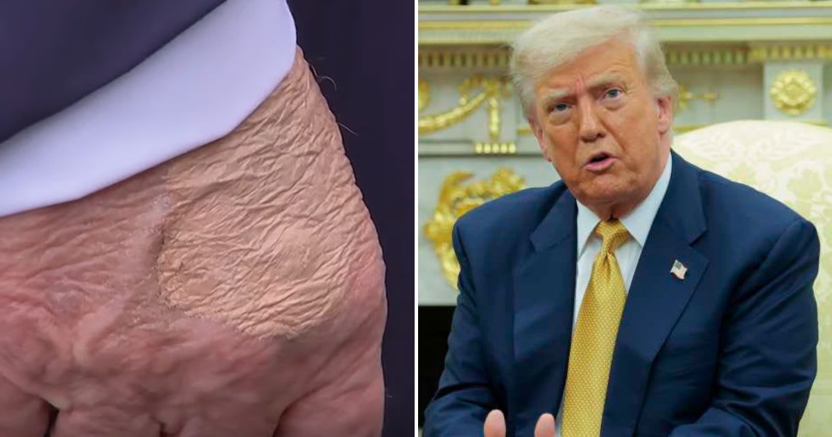 Experts reveal reasons behind mystery marks on Donald Trump’s hand amid health concerns
