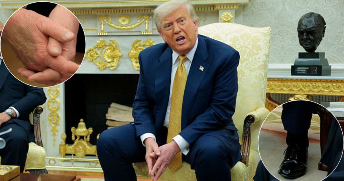 Trump diagnosed with chronic venous insufficiency after 'mild' swelling in legs and visible hand bruising
