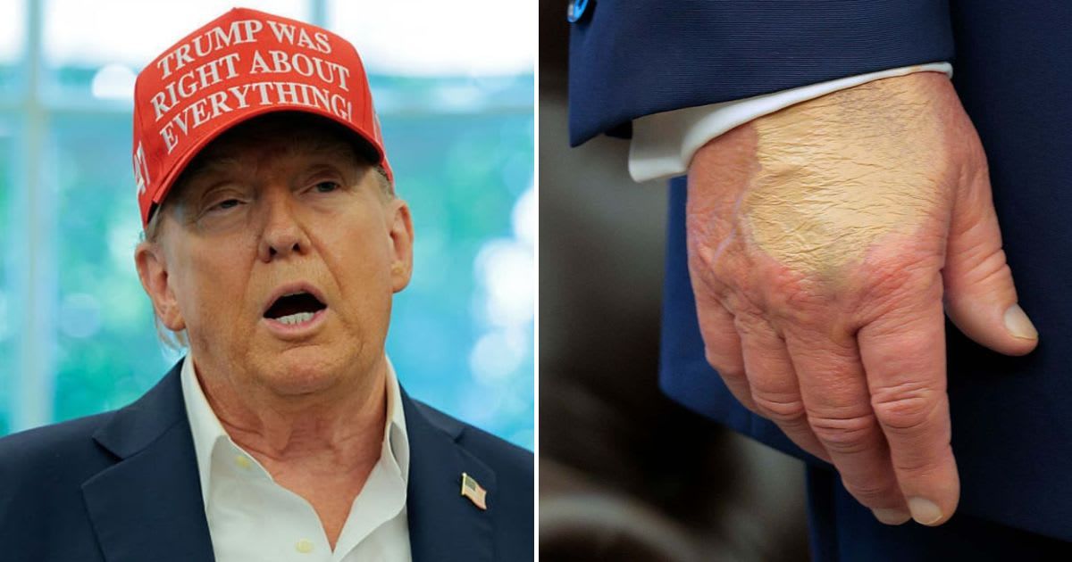 'Something is going on': Trump's heavily made-up hand looks sickly green, sparks health concerns again