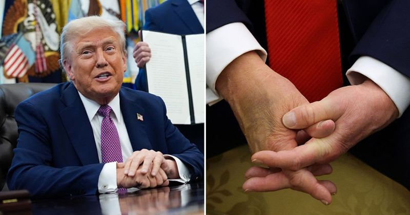  Trump appears to hide his bruised hand during Oval Office executive order signing