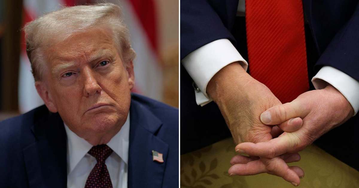 Trump’s mysterious hand bruise could be a 'blood clot', warns vascular surgeon