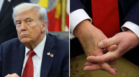 Trump’s disappearance on 24th reignites conspiracy theories over his recurring hand bruise