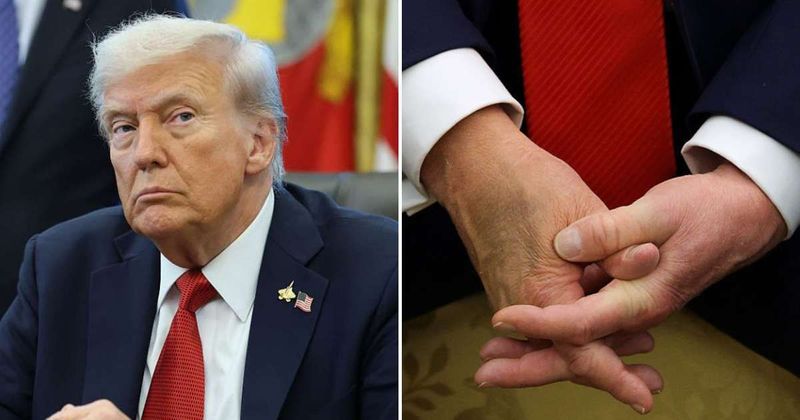 Trump’s disappearance on 24th reignites conspiracy theories over his recurring hand bruise