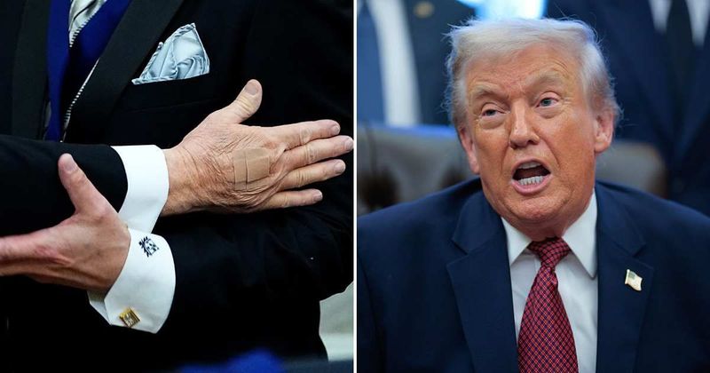 Trump's bandaged hand visible for fifth straight day at Kennedy Center Honors