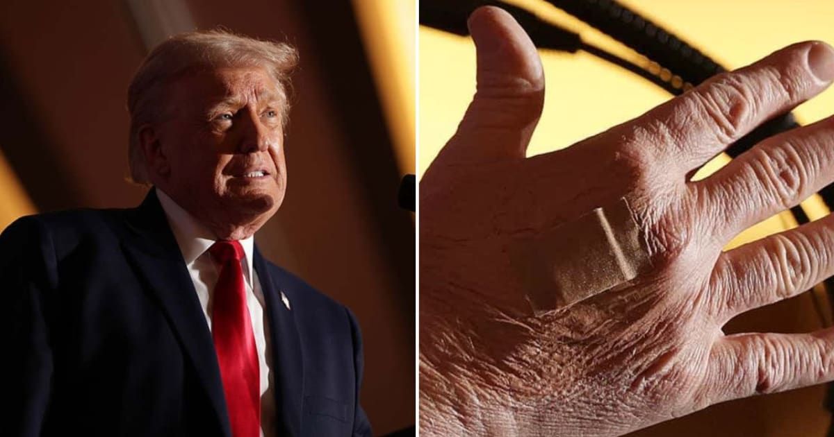 A bandage is visible on Donald Trump's right hand as he delivers remarks during an event at Mount Airy Casino Resort on December 9, 2025, in Mount Pocono, Pennsylvania (Alex Wong/Getty Images, Alex Wong/Getty Images)