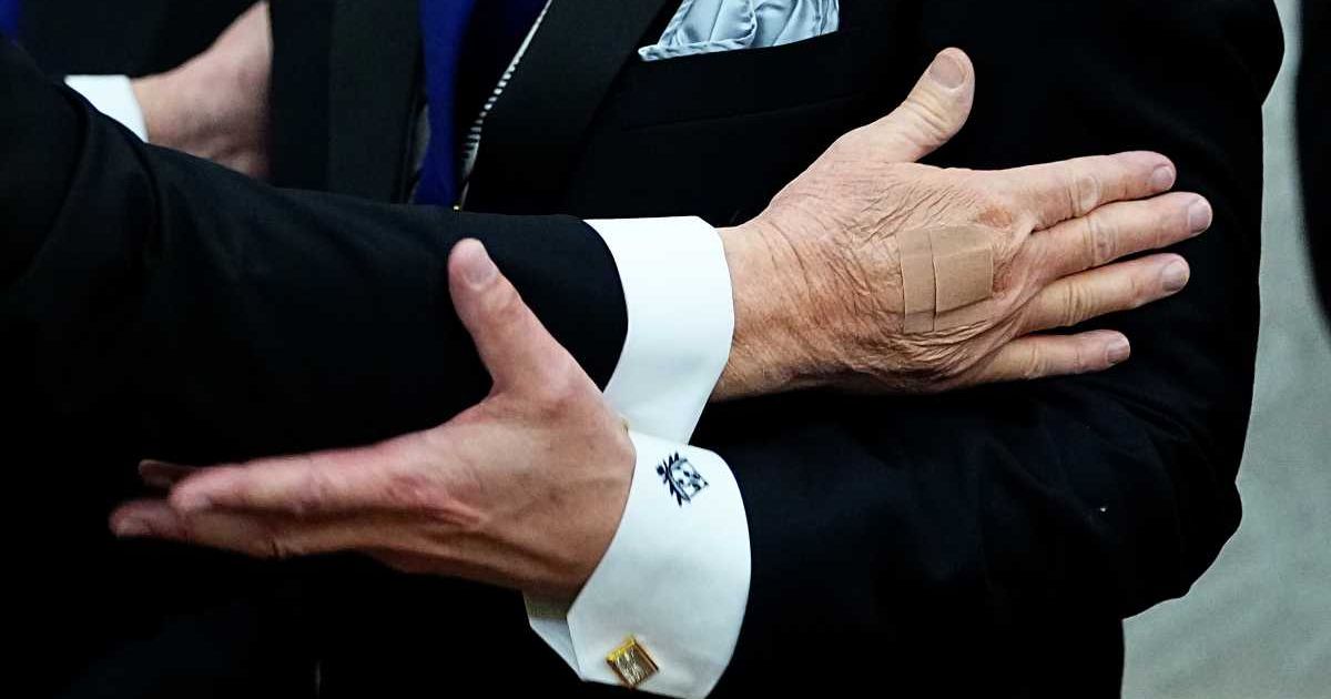 Bandages are visible on the hand of US President Donald Trump during the medal presentation ceremony for the 2025 Kennedy Center Honorees in the Oval Office of the White House on December 06, 2025, in Washington, DC (Aaron Schwartz/Getty Images)