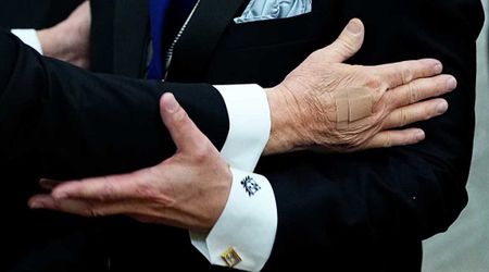 ‘Bruises spread’: Report reveals alarming claims about Trump’s ‘hole in hand’