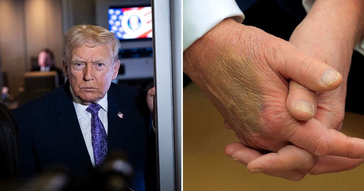 Donald Trump has frequently sparked health concerns over bruising on his hands (Getty Images)