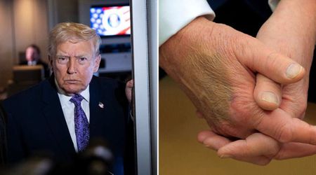 Trump’s bruised hands are ‘completely normal’, Fox News doctor says
