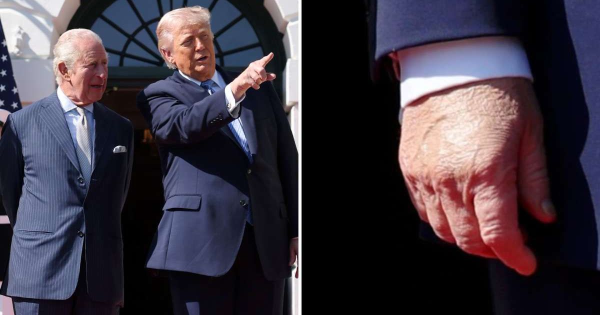 Donald Trump’s appearance with King Charles III drew fresh attention to visible discoloration on his hands (Getty Images)