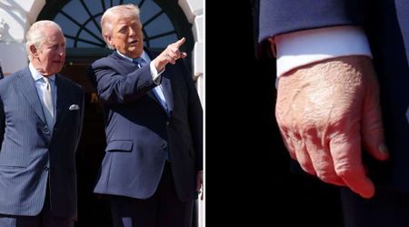 Trump’s ‘left-hand discoloration’ resurfaces in photos with King Charles, health concerns resurface